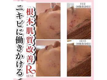 ホワイトアクア 新宿本店(WHITE AQUA)/ハーブピーリング/東京/新宿