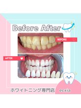 エクシアホワイトニング 札幌中島公園店/BeforeAfter［ホワイトニング］ 