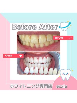 エクシアホワイトニング 札幌中島公園店/BeforeAfter［ホワイトニング］ 