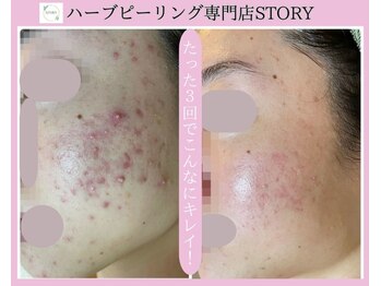ストーリー(STORY)/ハーブピーリング専門店STORY