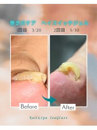 巻き爪ケア2本2回目