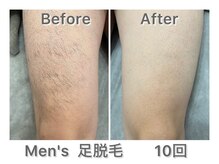 ナルシス/【足まるごと脱毛】10回の変化★