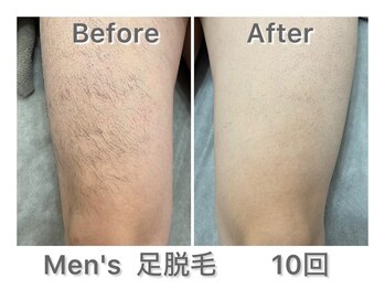 ナルシス/【足まるごと脱毛】10回の変化★