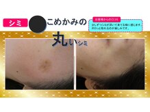 ビューティークリニーク アマーレ(Amare)/●丸い黒いシミ