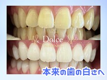 ドルチェ(Dolce)/ビフォーアフター