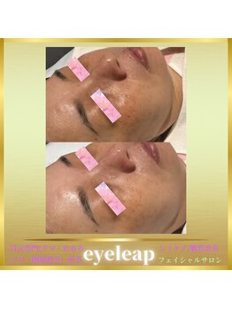 アイリープ(eyeleap)/☆【水光保湿肌美人】