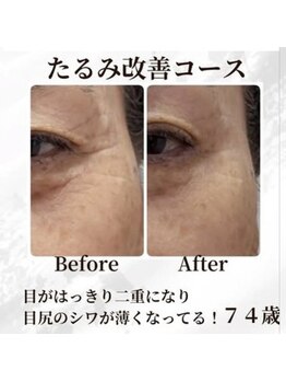 ミヤビ(MIYABI)/ラジオ波