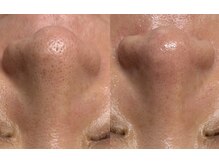 プラチナスタイル(platinum.style)/水素水毛穴洗浄 before after