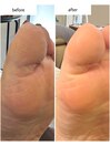 足裏角質ケア