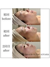 サロン ド ブラン アオヤマ(Salon de BLANC AOYAMA)/BLANC式小顔コース