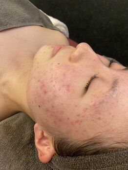 アリィ(Alii hisaya)の写真/【ニキビケア・肌質改善に特化★】結果重視◎諦めていたニキビケア・肌の凸凹・毛穴へ徹底アプローチ！