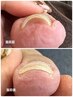 特許出願！巻き爪補正 ¥3300～