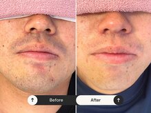 パッソ(Passo)/清潔感UP 肌荒れ改善　ビゲ脱毛