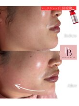 フォトビズ/二重あごたるみ/レッドショット