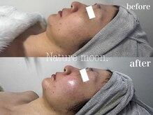ナチュールムーン(Nature moon.)/ハーブピーリング