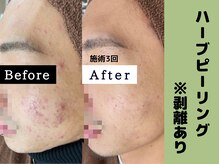 シャルムクリニカルサロン 池袋(Charme clinical salon)/ハーブピーリング※剥離あり