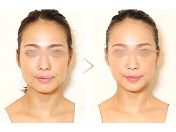 アリア/大人気の筋膜フェイシャル