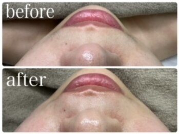 エクラニーク(Eclanique)/お口周りのしつこい毛【脱毛】