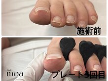 モア(moa)/巻き爪補正　新所沢モア　moa