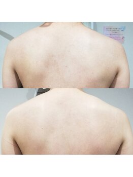 RiとBiのたまご/(ブライダル)2回beforeーafter