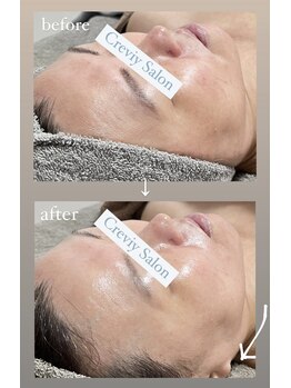 クレヴィー(Creviy)/陶肌トリートメント1回の変化