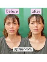 ゲンキ鍼灸整骨院(Genki鍼灸整骨院)/ほうれい線たるみのケアに美容鍼