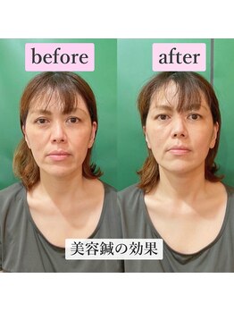 ゲンキ鍼灸整骨院(Genki鍼灸整骨院)/ほうれい線たるみのケアに美容鍼