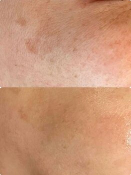 ラエッセ 恵比寿(LAESSE)/毛穴・美白専門店 LAESSE 恵比寿