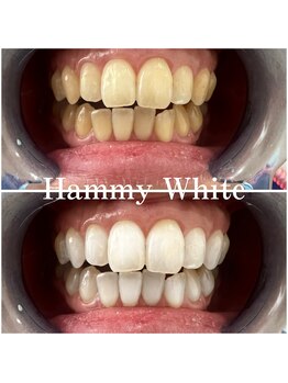 ハミーホワイト(Hammy White)/長年の黄ばみも