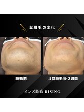 ライジング 熊本菊陽光の森店(RISING)/ヒゲ脱毛４回の変化