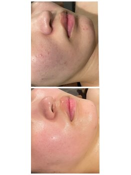 エステサロン 美飾り イオンモール木更津店/before⇒after/ララピール