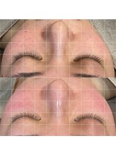 朱華0369(shuka)/鼻の角栓のつまり