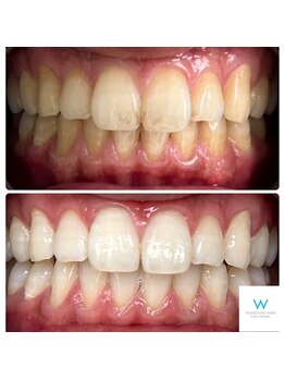 ホワイトニングショップ 奈良生駒店/1回でこんなにも！