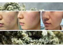 美肌に特化したよもぎ蒸しで代謝を促進&内面から肌荒れ体質卒業