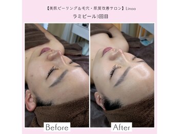 リノア 堀江(Linoa)/毛穴洗浄＆水光肌ピーリング