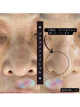 美山堂/帯広発のプラズマフェイシャル