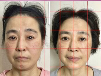 整体サロン プラスエル 東向島(Plus L)/小顔★ビフォーアフター