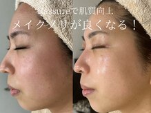 ラシュール(Rassure)/くすみ改善/ビオフィート