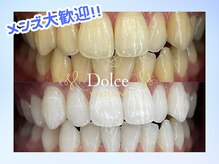 ドルチェ(Dolce)/ビフォーアフター