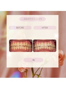プラスビー 2号店(+b)/ホワイトニングビフォーアフター