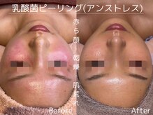 ビューティーサロンリア 栄 伏見店(LI'A)/肌質改善(施術1回)