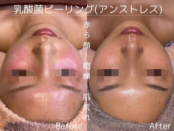 ビューティーサロンリア 栄 伏見店(LI'A)/肌質改善(施術1回)