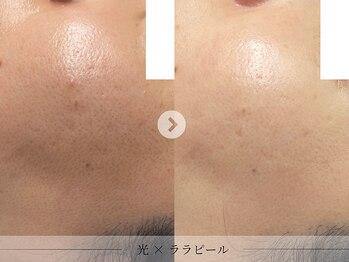 スパレーカ(Spa laka)/毛穴・凹凸ケア
