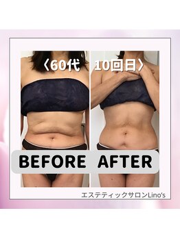 リノズ(Lino's)/【痩身】キャビゼロ