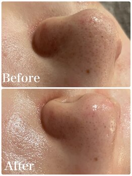 ミーアップ(Me up)/毛穴コースはこちらがおすすめ!