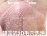 ◆周年キャンペーン◆韓国式3D毛穴洗浄２回目施術《男女同額》¥０