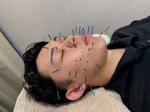 あすか鍼灸整骨院 アスカボディファクトリー(ASUKABodyFactory)/男の美容習慣に美顔鍼！