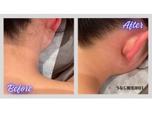 リボーン(Re bone)/人気急上昇★全身脱毛