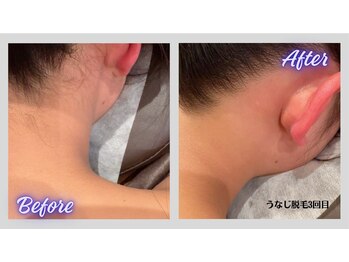 リボーン(Re bone)/人気急上昇★全身脱毛