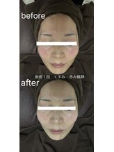 ビゼン(BIZEN)/【顔の赤みにお悩みの方】